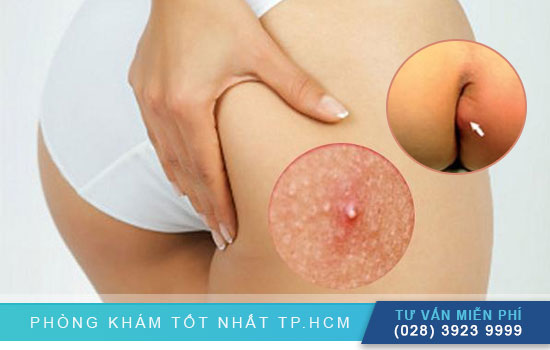 Hình ảnh các loại mụn ở mông thường gặp – cách điều trị [TPHCM - Bình Dương - Đồng Nai - Long An - Tiền Giang]
