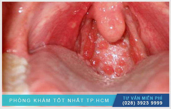 Hình ảnh họng bình thường và hình ảnh họng bị viêm chi tiết [TPHCM - Bình Dương - Đồng Nai - Long An - Tiền Giang]