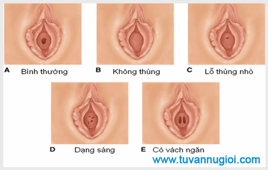 Hình ảnh màng trinh bình thường ở nữ giới