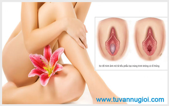 Hình ảnh màng trinh bình thường dạng bít kín