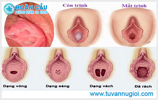 Hình ảnh màng trinh bình thường như thế nào?