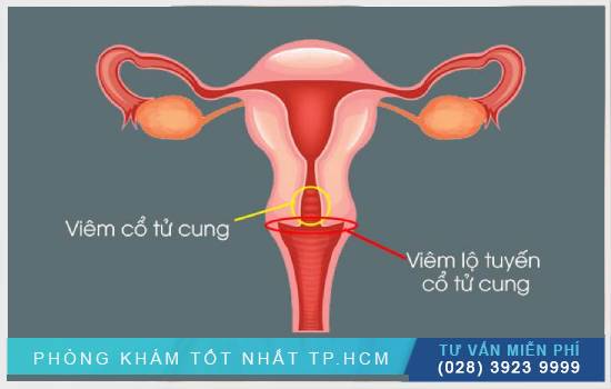 Chỉ dẫn cách chữa trị viêm cổ tử cung tại nhà Huong-dan-cach-chua-viem-co-tu-cung-tai-nha-1