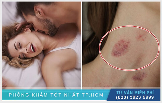 Hướng dẫn cách hickey đậm và an toàn nên học ngay