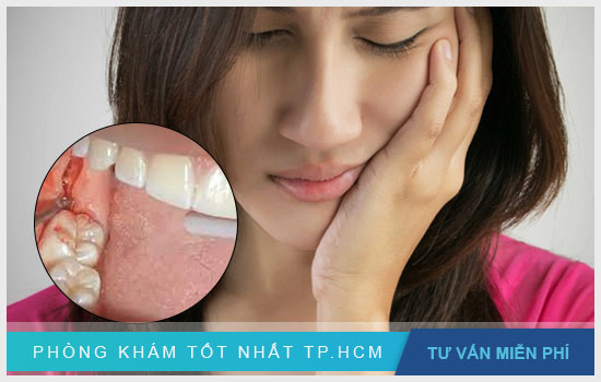 Tìm hiểu vệ sinh răng miệng sau khi nhổ răng khôn Huong-dan-ve-sinh-rang-mieng-sau-khi-nho-rang-khon3