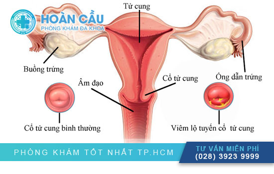 Viêm lộ tuyến cổ tử cung