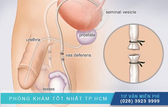 Làm thế nào để ngăn ngừa thai ngoài ý muốn? tham khảo ngay 8 cách hiệu quả