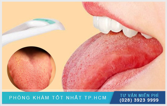 Lưỡi có nốt đỏ không đau là bệnh gì? Luoi-co-not-do-khong-dau-la-benh-gi-chua-bang-cach-nao