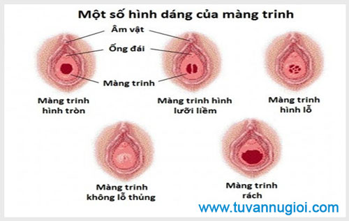 Màng trinh con gái như thế nào