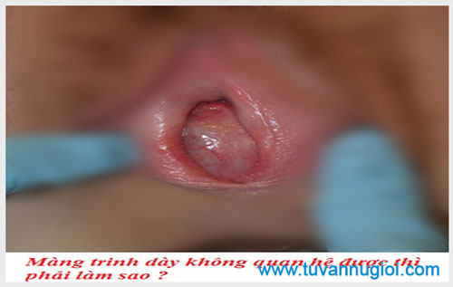 Màng trinh dày không quan hệ được thì phải làm sao ?