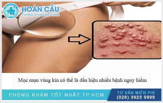 Mụn ở vùng kín có thể là biểu hiện nhiều bệnh lý nguy hiểm