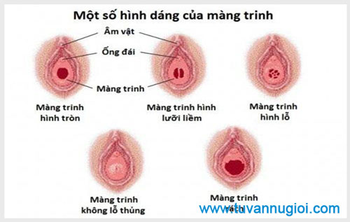 Một số điều cần biết về màng trinh