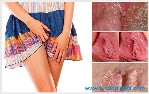 Mụn cóc sinh dục ở nữ giới và những biến chứng