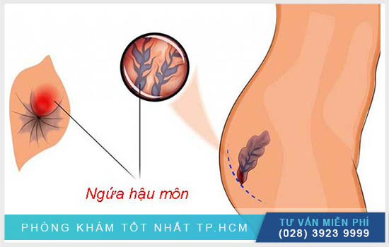 [TP.HCM] Ngứa hậu môn: Nguyên nhân, triệu chứng và cách điều trị hiệu quả