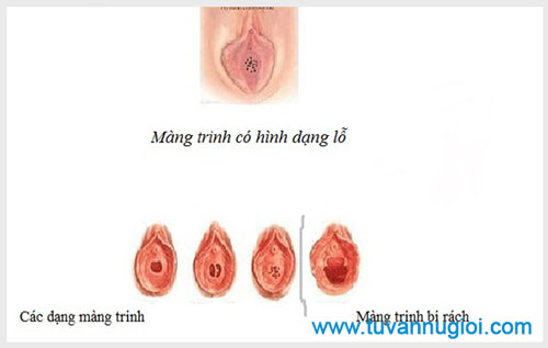 Nguyên nhân có thể gây ra rách màng trinh