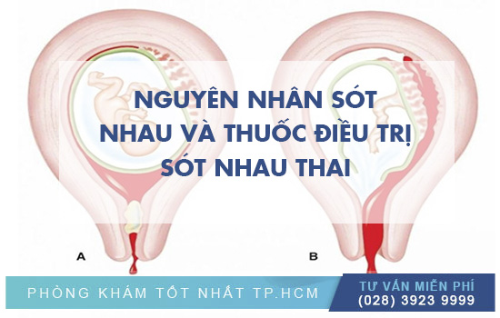 Nguyên Nhân Sót Thai Và Thuốc Điều Trị Sót Nhau Thai