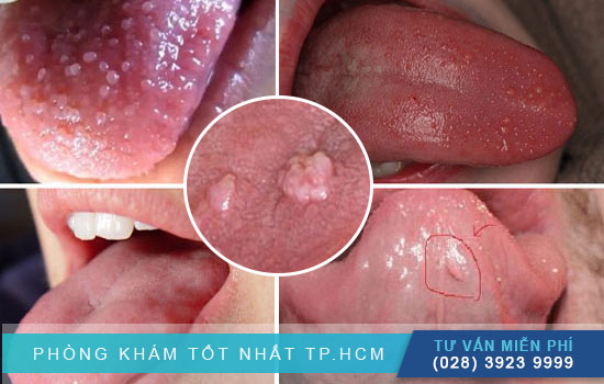 [TPHCM] Những bệnh lý điển hình gây nổi mụn thịt ở lưỡi cần chú ý