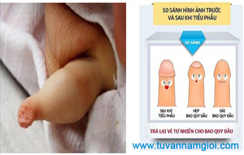Bao quy đầu: Dài – Hẹp – Nghẹt 