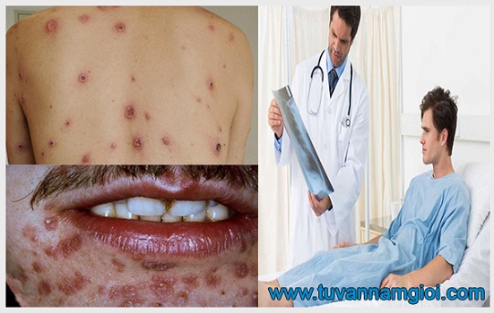 Cần sớm kiểm tra và chữa bệnh giang mai
