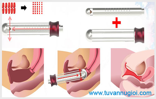 Những phương pháp thu nhỏ âm đạo hiệu quả