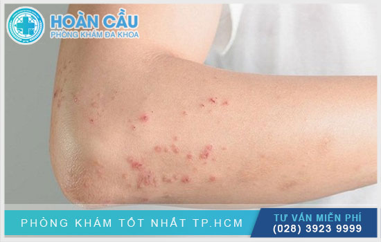 triệu chừng thường thấy của người mắc AIDS