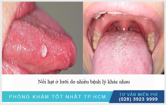 nổi hạt ở lưỡi do nhiều bệnh lý khác nhau