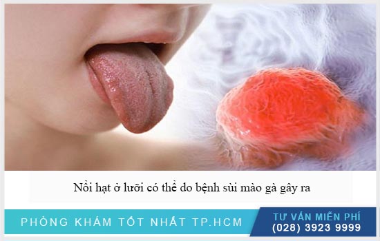 nổi hạt ở lưỡi do sùi mào gà gây ra