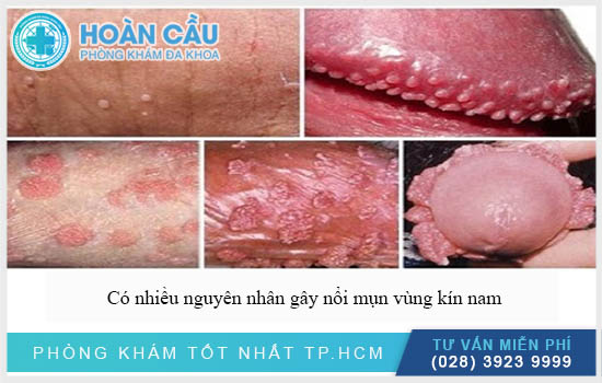 Có nhiều nguyên nhân gây nổi mụn vùng kín nam