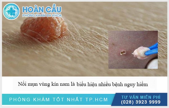 Nổi mụn vùng kín nam là biểu hiện nhiều bệnh nguy hiểm