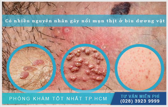 [TP.HCM] Nổi mụn thịt ở bìu dương vật do nguyên nhân nào và nam giới cần làm gì?