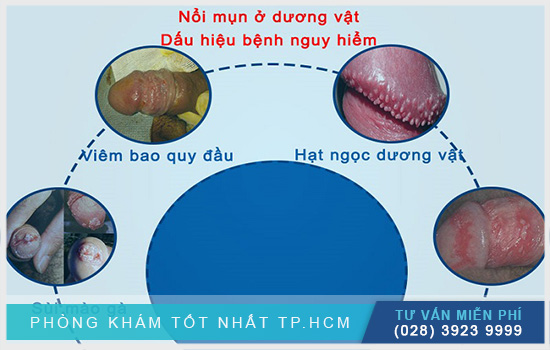 Nổi mụn trắng ở bao quy đầu là bị bệnh gì và chữa trị như thế nào để nhanh khỏi?