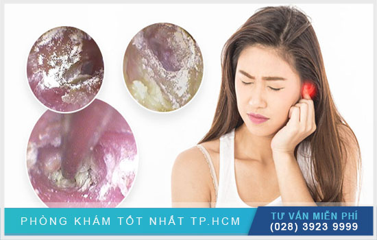 Phác đồ điều trị nấm tai hiệu quả [TPHCM - Bình Dương - Đồng Nai - Long An - Tiền Giang]