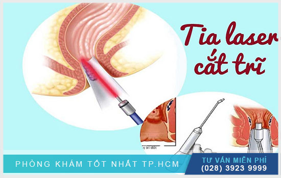 HCM - Phân tích tất tần tật các phương pháp cắt trĩ hiện nay Phan-tich-cac-phuong-phap-cat-tri-hien-nay-tren-thi-truong-2