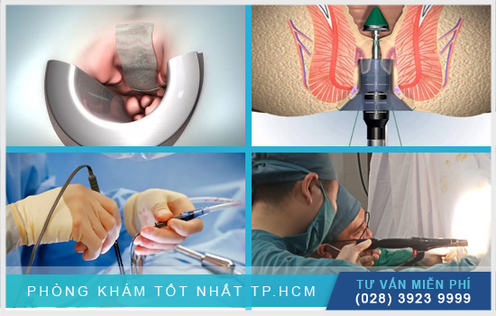 HCM - Phân tích cắt trĩ bằng phương pháp nào tốt nhất hiện nay  Phan-tich-cat-tri-bang-phuong-phap-nao-tot-nhat-hien-nay-2