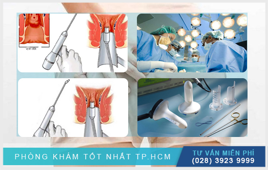 HCM - Phân tích cắt trĩ bằng phương pháp nào tốt nhất hiện nay  Phan-tich-cat-tri-bang-phuong-phap-nao-tot-nhat-hien-nay-3