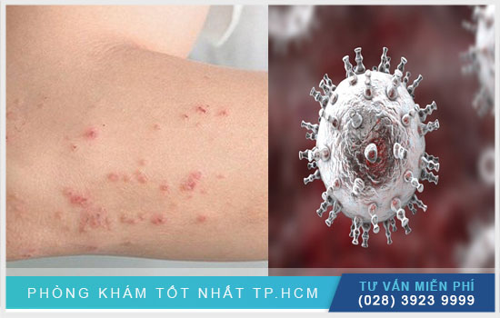 Phân tích herpes miệng có phải bị HIV hay không? [TPHCM - Bình Dương - Đồng Nai - Long An - Tiền Giang]