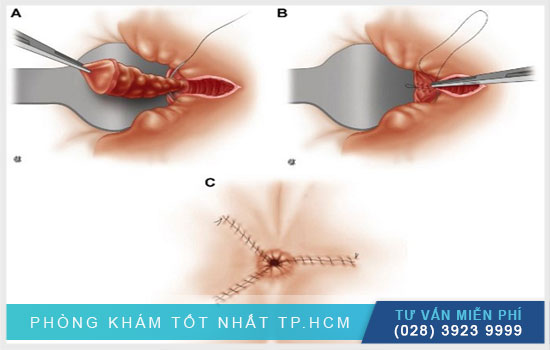 [TP.HCM] Phẫu thuật Milligan Morgan - phương pháp cắt trĩ giai đoạn nặng