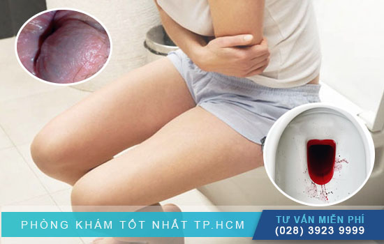 Phương pháp chữa trĩ ngoại HCPT Phuong-phap-chua-tri-ngoai-hcpt-hieu-qua-nhu-the-nao