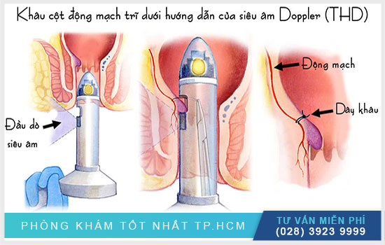 Khâu cột động mạch trĩ dưới theo hướng dẫn Doppler - THD