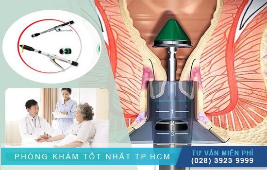 [TPHCM] Phương pháp phẫu thuật rò hậu môn hiệu quả
