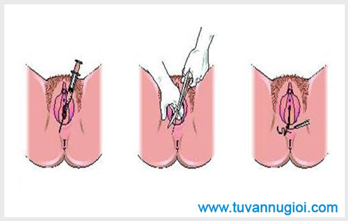 Quy trình thực hiện thu hẹp âm đạo