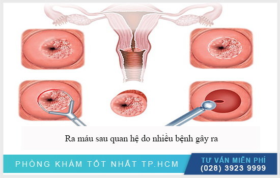 ra máu sau khi quan hệ do nhiều bệnh gây ra