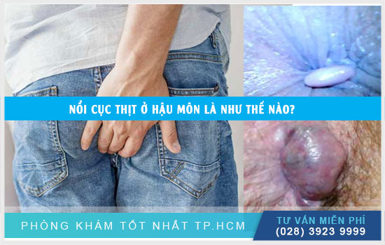 [TPHCM] Sờ thấy cục thịt ở hậu môn là bị bệnh gì?