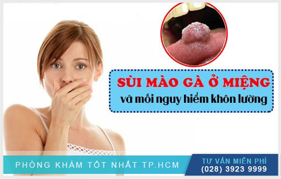 Sùi mào gà ở miệng