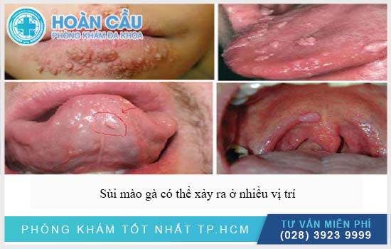 Bệnh sùi mào gà có thể xảy ra nhiều vị trí