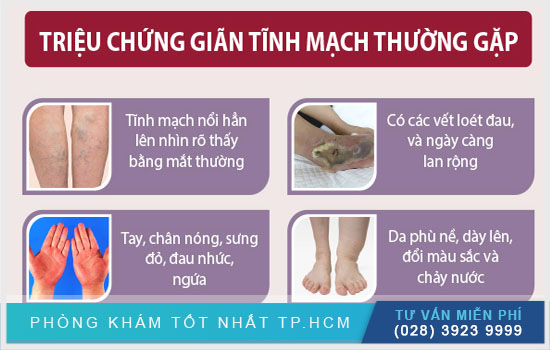 Dấu hiệu suy giẫn tĩnh mạch chân Suy-gian-tinh-mach-chan-co-nguy-hiem-khong-dieu-tri-bang-cach-nao