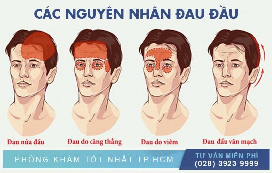 Các nguyên nhân hay bị đau đầu