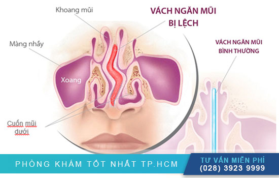 Phẫu thuật vách ngăn mũi là gì Tham-khao-ngay-phau-thuat-vach-ngan-mui-gia-bao-nhieu-tien