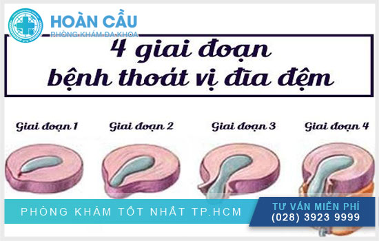 Nhận biết thoát vị đĩa đệm qua triệu chứng