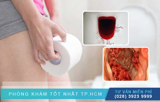 [TPHCM] Thông tin chính xác về bệnh trĩ là gì?