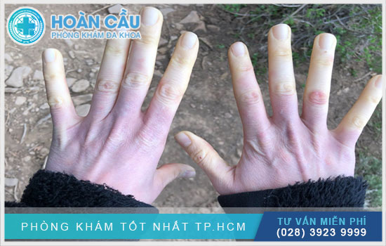 Liều dùng Adalat 10mg với hội chứng Raynaud